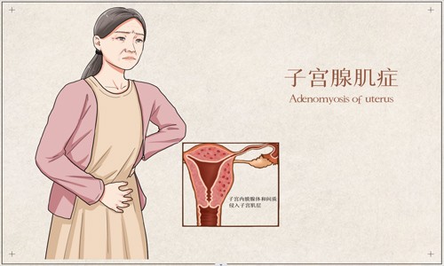 文獻(xiàn)解讀 | 單細(xì)胞 RNA 測序與空間轉(zhuǎn)錄組學(xué)相結(jié)合破譯的子宮腺肌病綜合轉(zhuǎn)錄圖譜