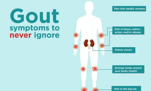 痛風案例 |Olink 助力系統(tǒng)炎癥因子圖譜繪制與新靶點發(fā)現(xiàn)